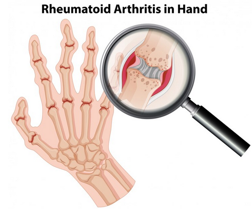 الالتهاب المفصلي الروماتويدي ((Rheumatoid arthritis (RA)